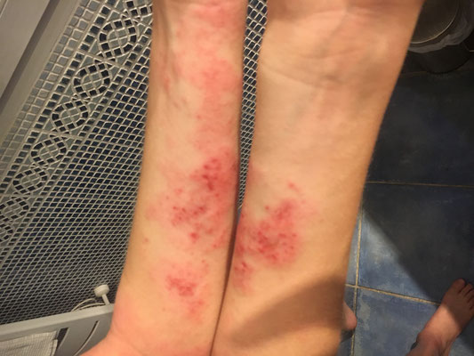 plaques  d'eczéma rougs infectées
