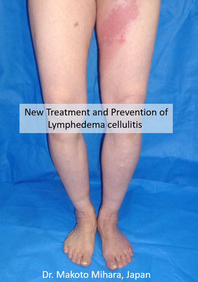 New treatment and Prevention of Cellulitis, Lymphedema Treatment Japan 