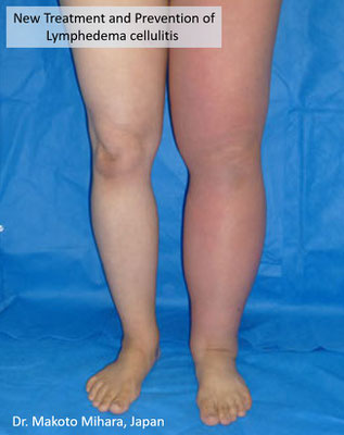 New treatment and Prevention of Cellulitis, Lymphedema Treatment Japan 