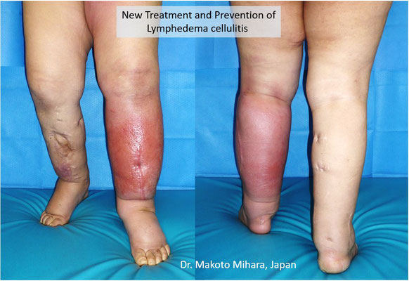 New treatment and Prevention of Cellulitis, Lymphedema Treatment Japan 