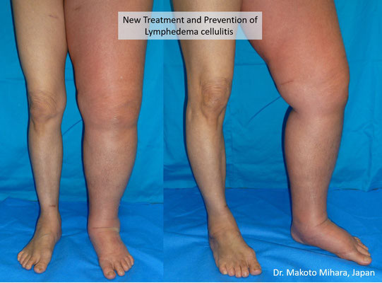 New treatment and Prevention of Cellulitis, Lymphedema Treatment Japan 