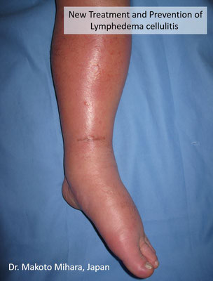 New treatment and Prevention of Cellulitis, Lymphedema Treatment Japan 