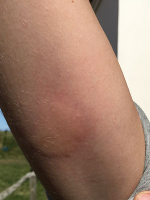 Mückenstiche Allergische Reaktion