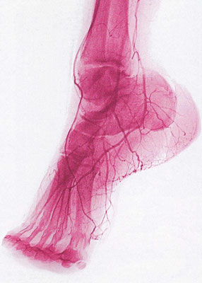Photo du même pied observé en radiographie. Les vaisseaux (artères et veines) apparaissent sous la forme de tubes rouges.