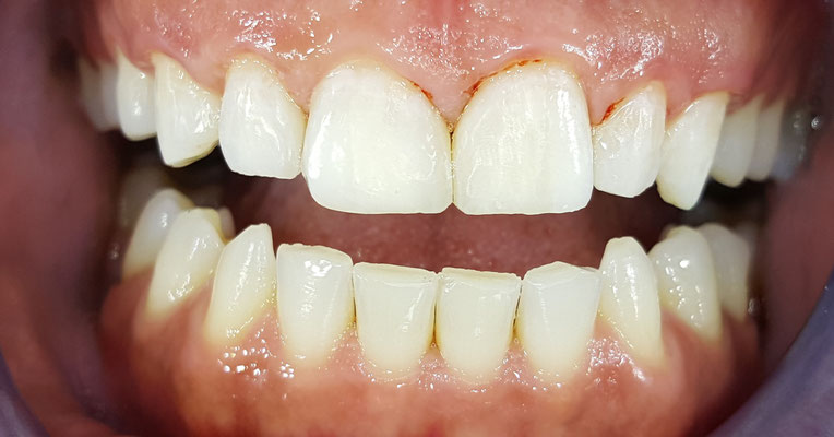 Das Endergebnis: Weisse Zähne ohne Zahnlücken