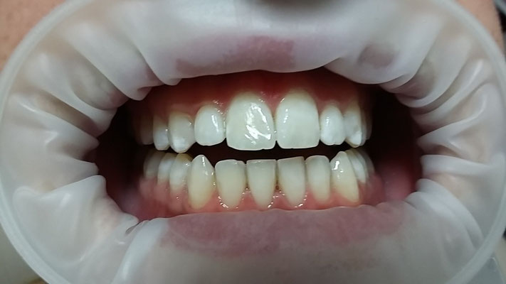 NACH der Zahnaufhellung