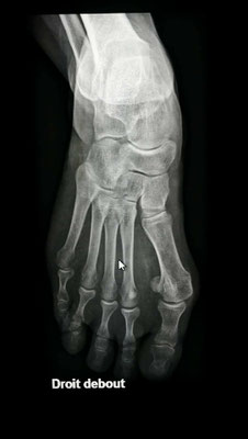 hallux valgus