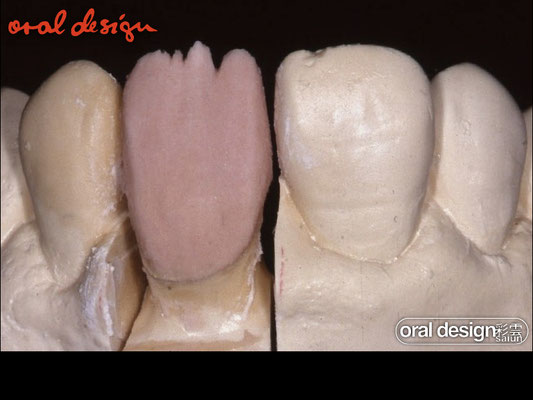 ８）象牙質の形態回復.