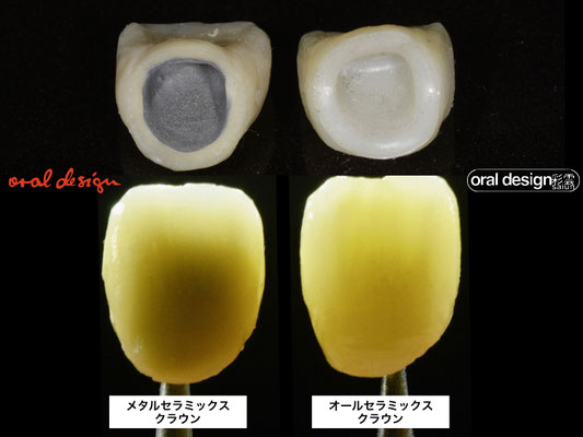 ５）透過光での各クラウン。メタルセラミックスの場合にはメタルコーピングの影が見える。ジルコニアコーピングの場合には、コーピングの影が無い。