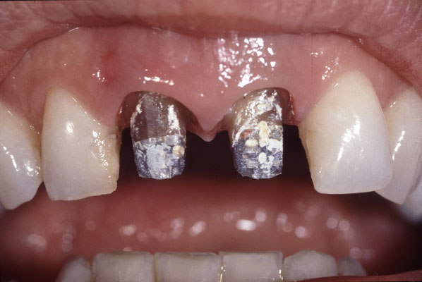 1994年29歳の時。私がWIlli Geller氏のラボに留学した時に、私に患者を受け持たせてもらった時の上顎中切歯2本のセラミックスクラウンのケース。