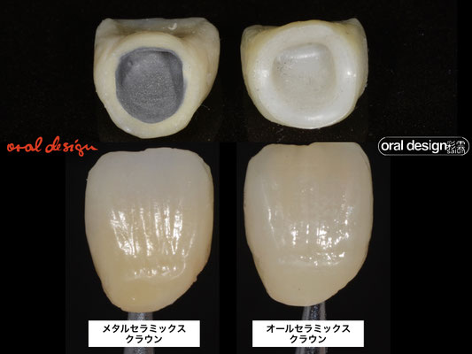 ４）メタルセラミックスクラウンと、オールセラミックスクラウン。外見的にはどちらも変わりはないが、内面はメタル（黒）、ジルコニア（白）である。