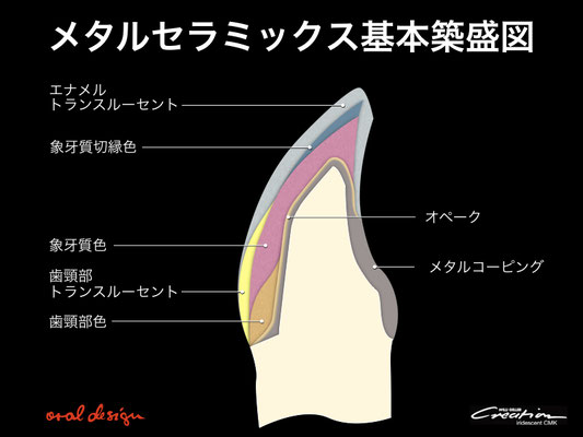 １）メタルセラミックスの基本築盛図。