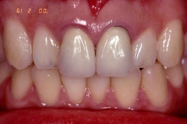 図-2. この中切歯２本のメタルセラミックスクラウンも比較的きれいに製作されている。本来の審美という点から考えると、周りの歯牙の色調とは調和していないことがわかると思う。