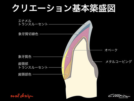 １）メタルセラミックスの基本築盛図.