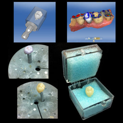 Empreinte Optique et E.MAX Cerec