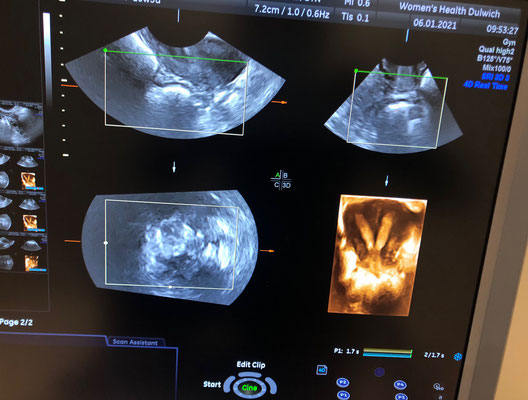 4D image of congenital uterine anomalies