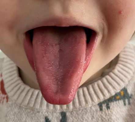 Na tweede behandeling is de tong zo goed als normaal en spreekt kind meer dan ooit, ademhaling terug naar normaal