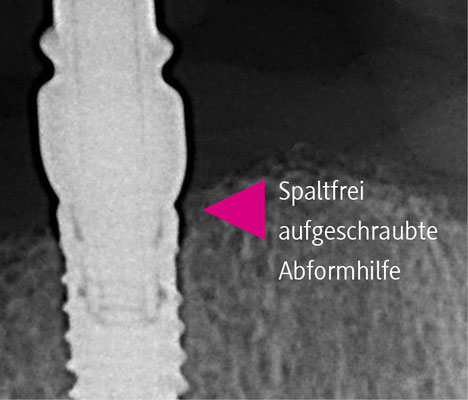 Spaltfrei aufgeschraubte Abformhilfe