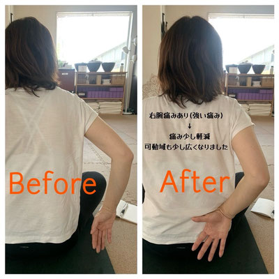 右腕があがらなくなった方