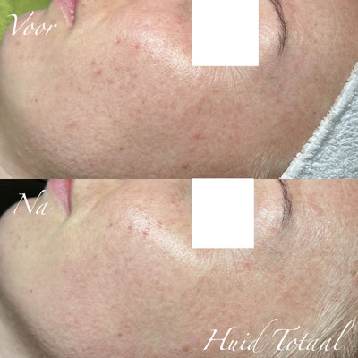 Huidverbetering met de Herbal Bio Peel