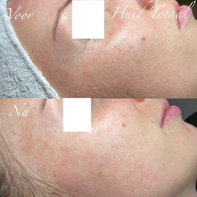 Huidverbetering met de Herbal Bio Peeling