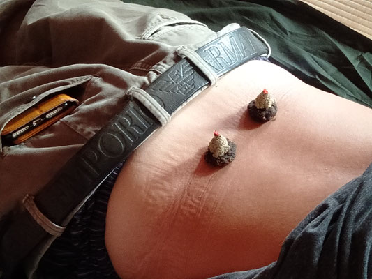 隔物灸