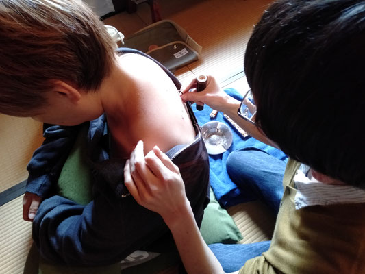 深谷灸法の実技