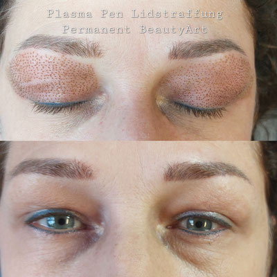 Plasma Pen Lidstraffung ohne OP bei Permanent BeautyArt in Kriens 