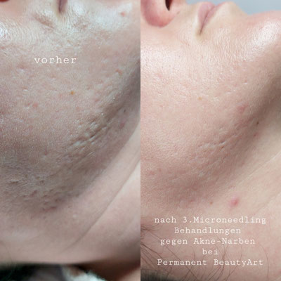Microneedling gegen Akne-Narben Kriens-Luzern 