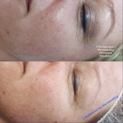 Microneedling Anti-Aging Kriens 