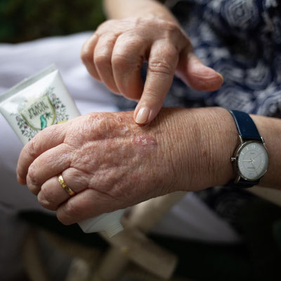 Handtherapie bei Arthrose, Gicht, Artritis, Gelenkschmerzen, Ergotherapie Praxis  Stein am Rhein und Ergotherapie Praxis Berlingen, Untersee u. Rhein