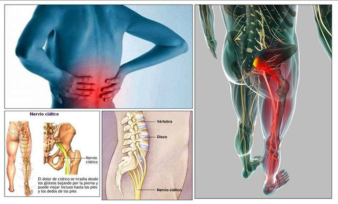 LA LUMBALGIA - Página web de Masajes y Herbolario RAQUIS