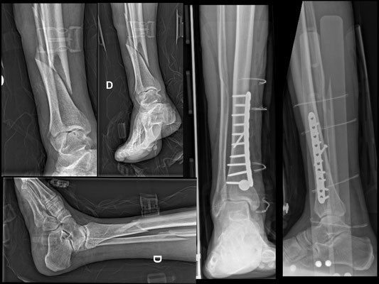 fracture quart inférieur de jambe : synthèse du tibia par une vis en compression et plaque de neutralisation. Fracture haute de fibula en traitement orthopédique. Dr Rémi chirurgie du sport Toulouse Croix du Sud