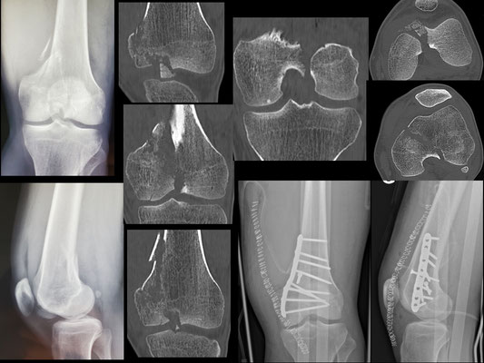 Fracture de Trélat comminutive (condyle interne du genou). synthèse plaque moulée sur mesure sur table orthopédique. Dr Rémi chirurgie du sport Toulouse Croix du Sud