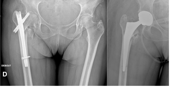 fracture pertrochantérienne enclouée, opérée ailleurs, balayage de la vis cervicocéphalique, reprise par prothèse totale, Dr Rémi Toulouse