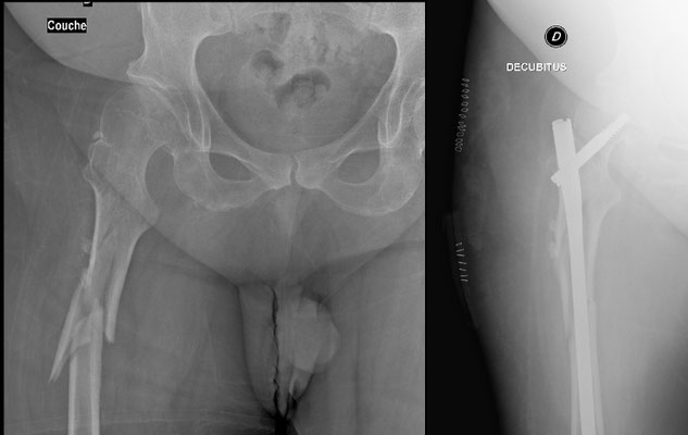 Fractura femur con displasia de cadera, cirugia deportiva : clavos intramedulares, fijacion percutanea. En pie inmediatamente.