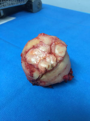 même patient, opéré pour mise en place de prothèse de hanche : le cartilage de la tête fémorale forme des ilôts curieux dans la zone de nécrose.