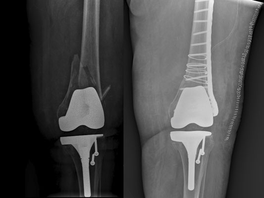 radio fracture sur prothèse de genou. Dr Rémi chirurgien orthopédiste Toulouse croix du Sud