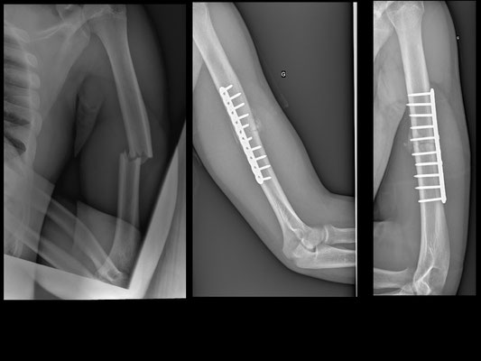 fracture diaphysaire de l'humérus. Neurolyse du nerf radial et plaque d'ostéosynthèse. Cal présent à un mois déjà (jeune). Dr Rémi chirurgie du sport Toulouse Croix du Sud.
