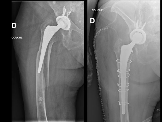 Fracture sur PTH sur centenaire. Dr Rémi Croix du Sud, Toulouse.