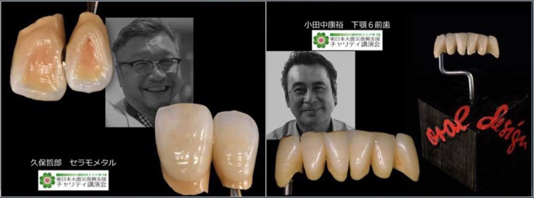 Tetsuro Kubo "Maxillary Central Incisors / Lateral Incisors Metal Ceramics Sample" / Yasuhiro Odanaka "Metal Ceramic Bridge with 6 Mandibular Anterior Teeth"