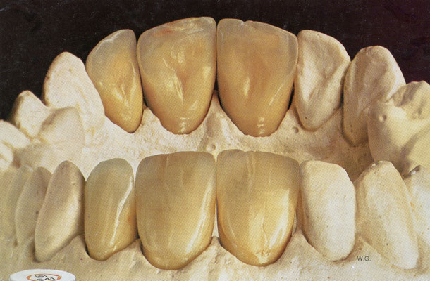 In the lower right of the photograph, the initials “W.G.” are visible in small letters on the interdental papilla between the lateral incisor and canine.