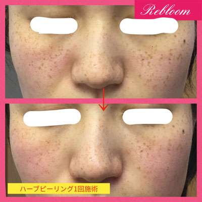 Bio ハーブピーリング Rebloom 104 ページ