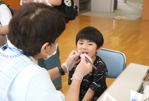 フッ素塗布