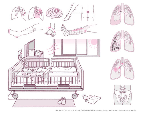 看護雑誌「プチナース11月号(2023年)」・付録「周術期標準看護計画BOOK」挿絵