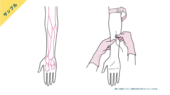 前腕の静脈血管の走行・静脈内注射の手技(2色刷)