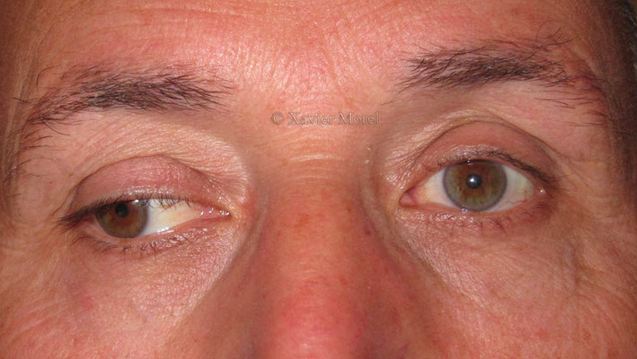 Hypotropie oeil droit avec faux ptosis