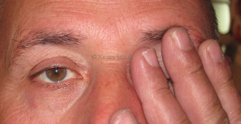 Le ptosis disparait au cover test de l'oeil gauche