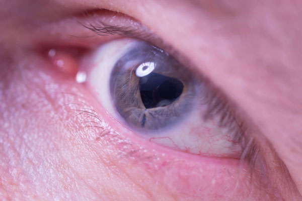 Schere im Auge