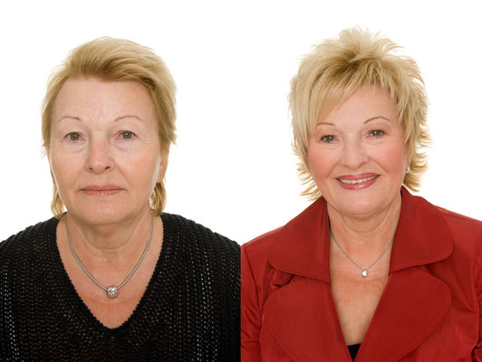vorher nachher Foto
